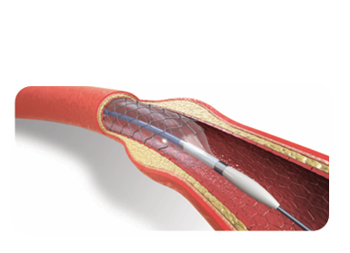 STENT YUKON CHOICE FLEX
